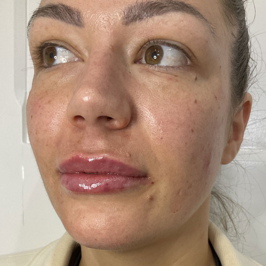 About Face Clinic client results after dermal lip filler