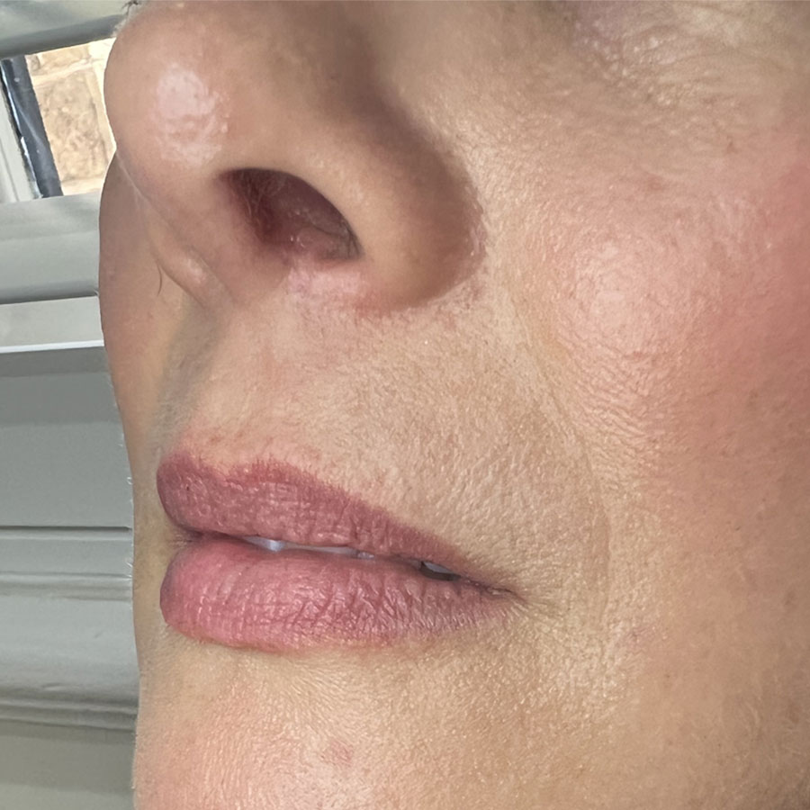 About Face Clinic client before lip dermal filler