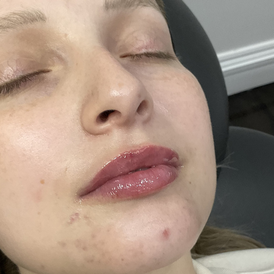 About Face Clinic client results after lip dermal filler