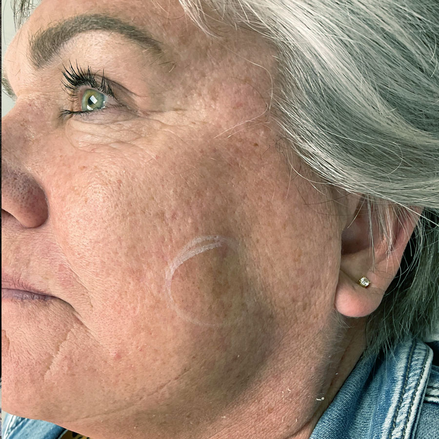 About Face Clinic client after limelight skin rejuvenation