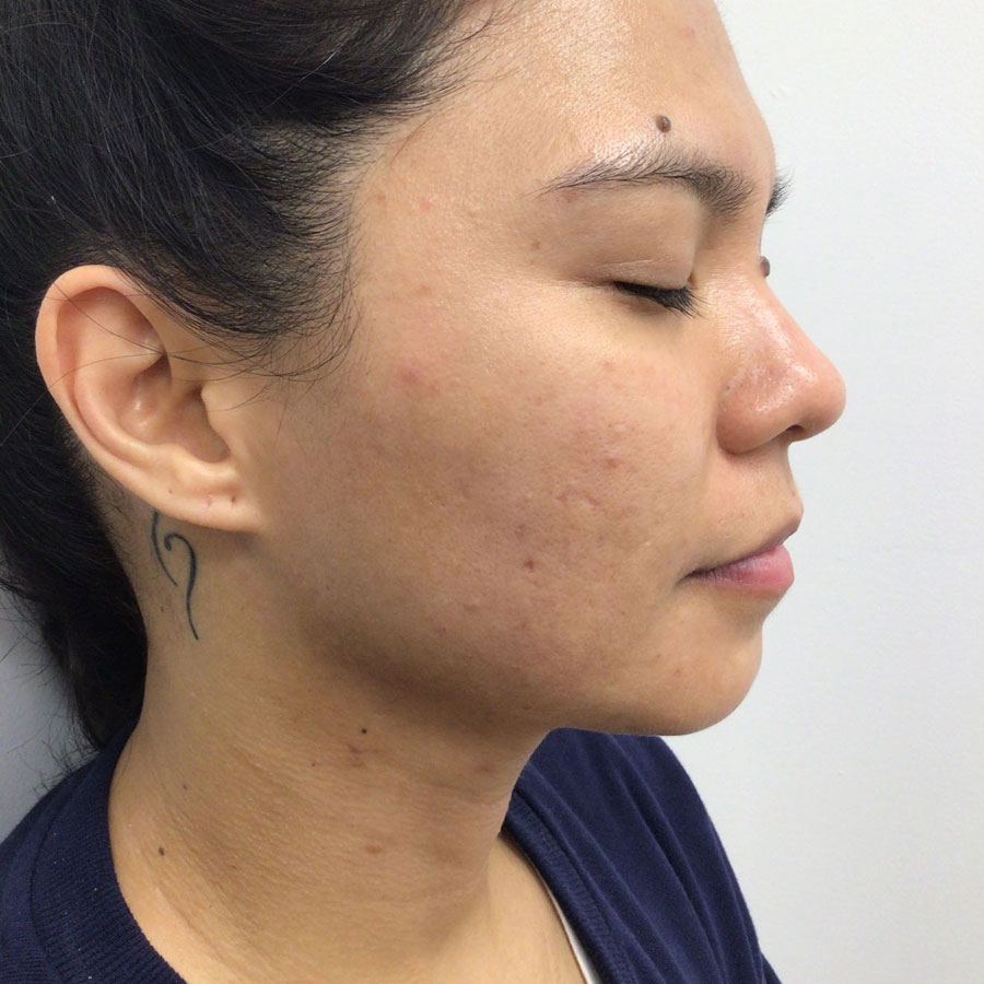 About Face Clinic client after skin rejuvenation