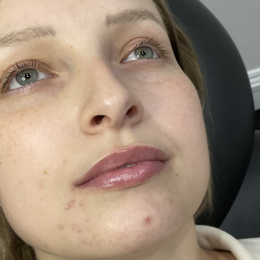About Face Clinic client before lip dermal filler 