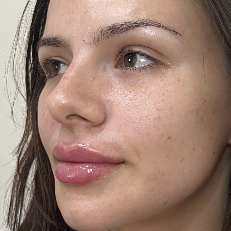About Face Clinic client results after lip dermal filler