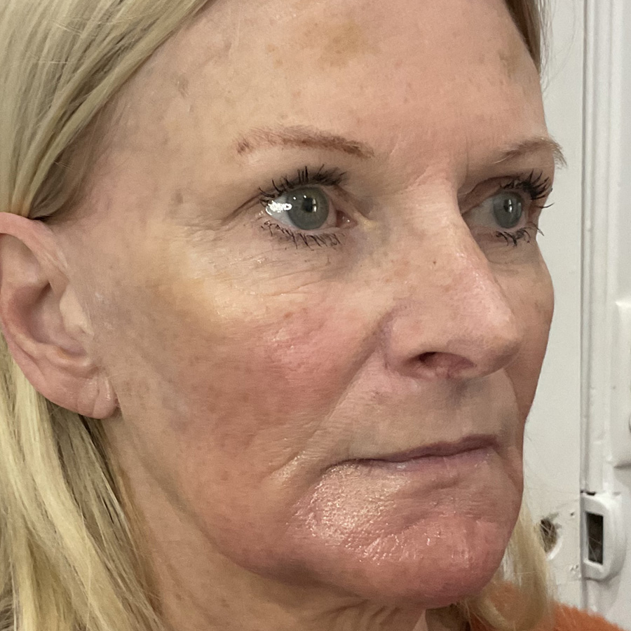 About Face Clinic mature client results after dermal filler
