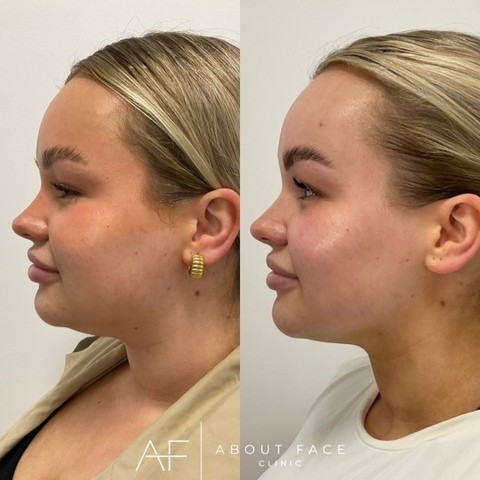 About Face clinic client before and after-fat-dissolving