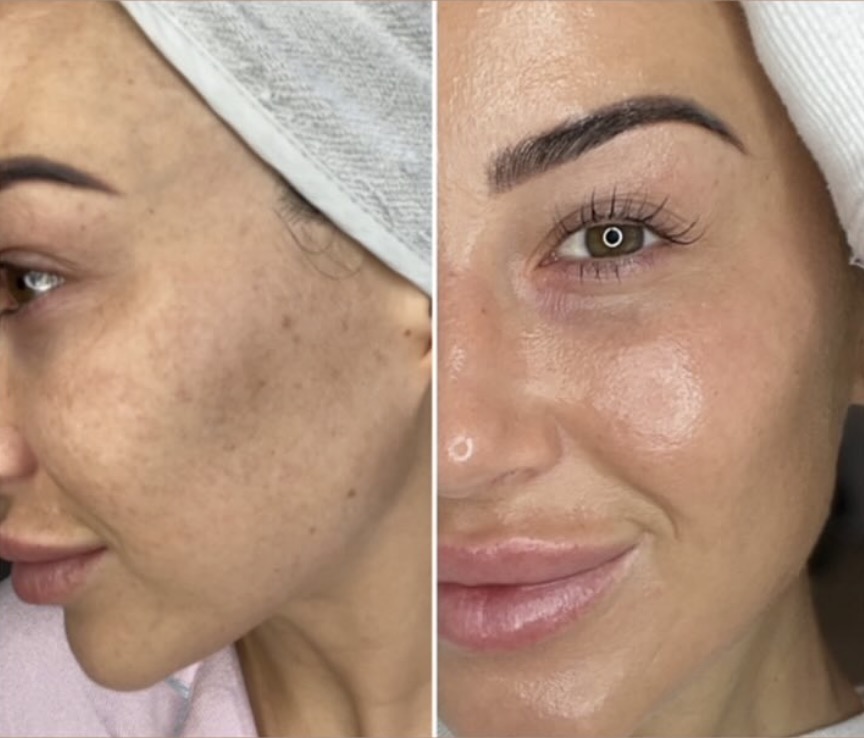 Cosmelan® facial pee before and after treatment