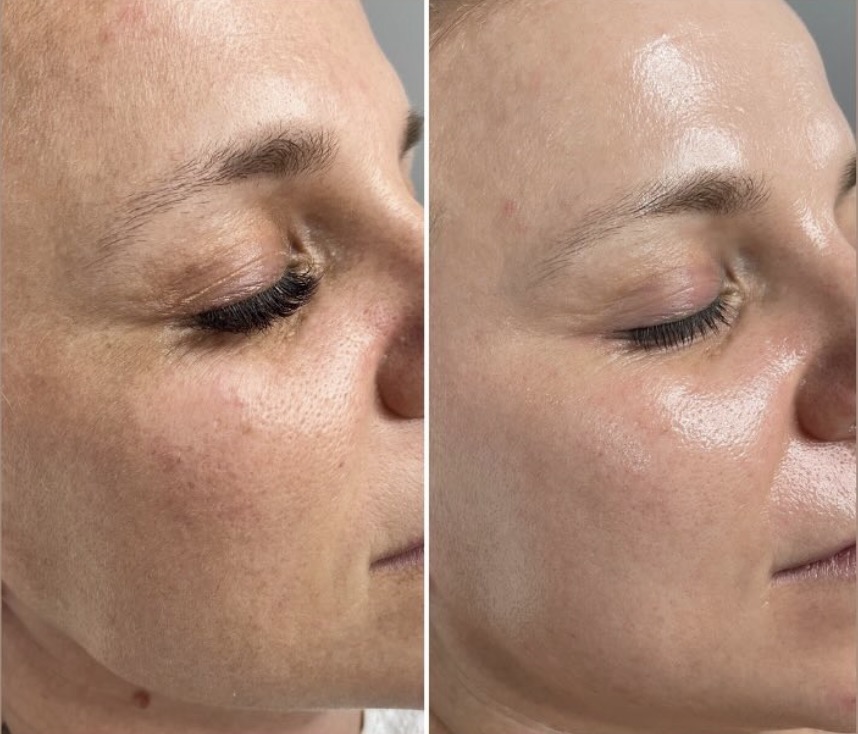 Cosmelan® facial pee before and after treatment